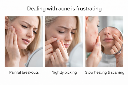 CLEARSKIN™ Invisible Acne Repair Patch – Fast, Clean & Discreet Spot Treatment